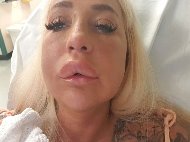 Làm đẹp - Tiêm tan filler, cựu người mẫu suýt chết, môi sưng vêu như ong đốt