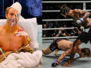 Thể thao - Hãi hùng võ sỹ MMA: 29 giây bị hạ, 8 vết nứt xương &amp; 9 giờ phẫu thuật