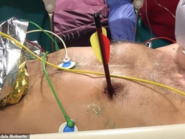 Phi thường - kỳ quặc - Người đàn ông tự bắn nỏ từ trước ngực xuyên qua tim ra sau lưng