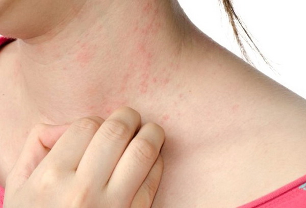 Các loại thực phẩm dễ gây dị ứng và cách đề phòng - 2