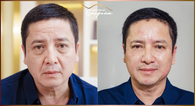 Đi tìm lời giải cho việc trẻ hóa làn da quanh mắt - 4