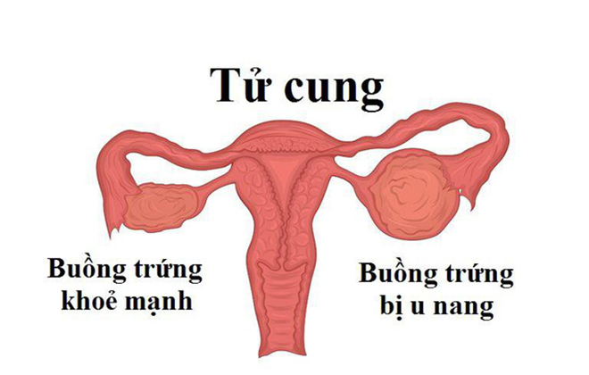 Biến chứng u nang buồng trứng nguy hiểm như thế nào? - 1