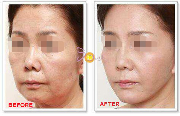 Trẻ lại 15 tuổi sau 60 phút nhờ công nghệ Thermage FLX 4.0 phiên bản 2019 - 2