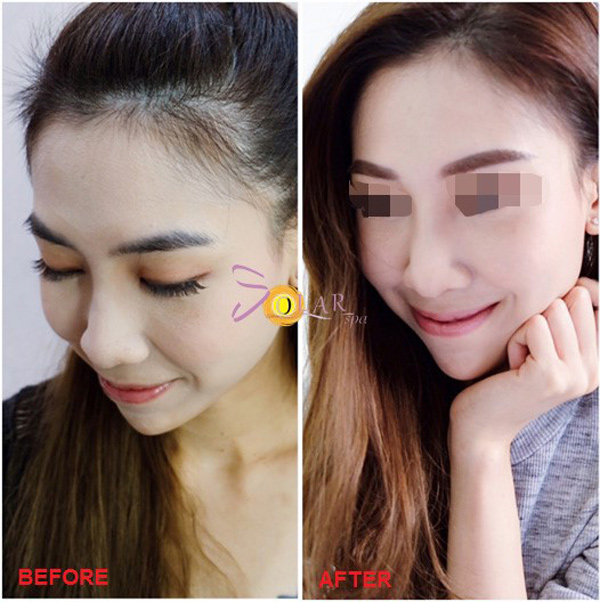 Trẻ lại 15 tuổi sau 60 phút nhờ công nghệ Thermage FLX 4.0 phiên bản 2019 - 3