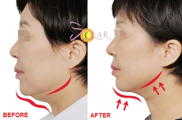 Trẻ lại 15 tuổi sau 60 phút nhờ công nghệ Thermage FLX 4.0 phiên bản 2019 - 4