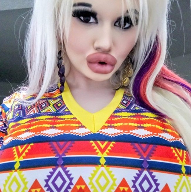 Tiêm axit vào môi để giống búp bê, cô gái bị chê như... quái vật - 2