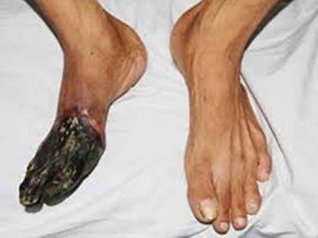 Sức khỏe đời sống - "Món" cả chục triệu người đang mê mẩn là thủ phạm gây ra bệnh chân khô như ...gỗ