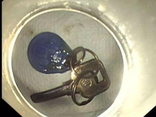 Phi thường - kỳ quặc - Đau ngực dữ dội, thanh niên TQ sốc với thứ mình nuốt phải