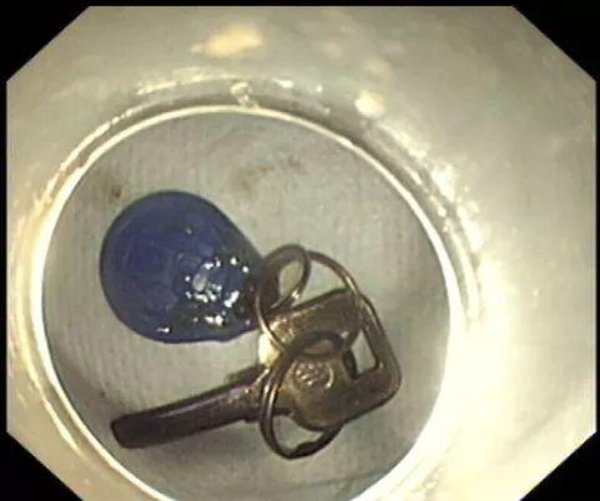 Đau ngực dữ dội, thanh niên TQ sốc với thứ mình nuốt phải - 1