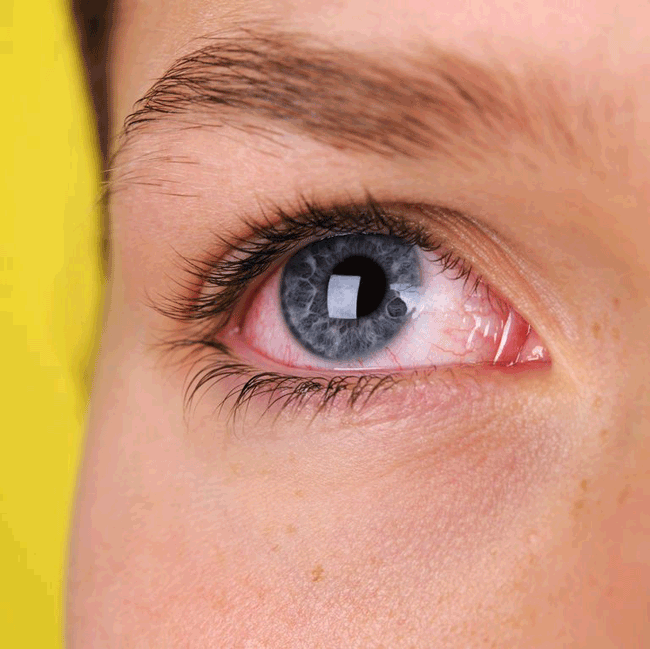 1. Mắt đỏ ngầu: Theo Cory Fisher, bác sĩ tại Bệnh viện Cleveland đây có thể là dấu hiệu viêm kết mạc, thường đi kèm với các triệu chứng khác như sổ mũi, đau họng và ho. Nếu nó kéo dài hơn 1 tuần và không biến mất, bạn có thể gặp vấn đề sức khỏe lớn hơn như nhiễm trùng mắt hoặc bệnh tăng nhãn áp, thậm chí có thể là 1 căn bệnh nào đó gây mù lòa.