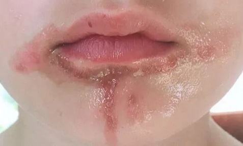 Bỏng đáng sợ vì ăn kem chanh giữa nắng - 2