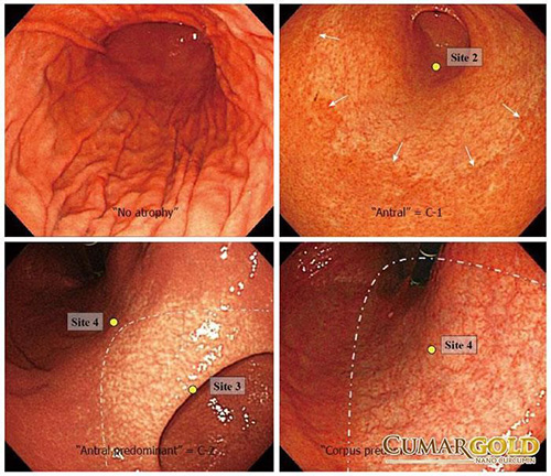 Cảnh báo: Những nguy hiểm của đau dạ dày, viêm hang vị - 1