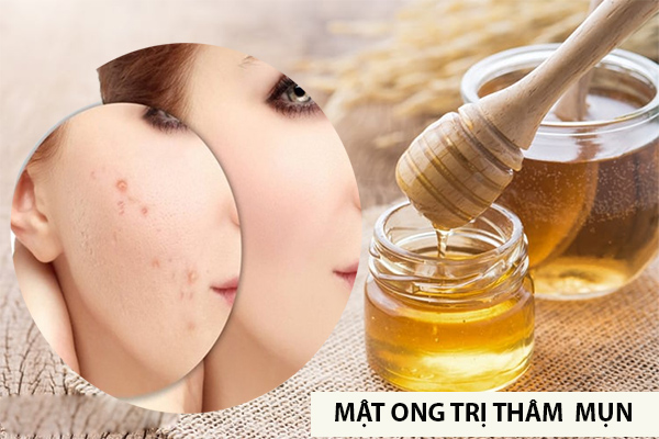 1. Tổng Quan Về Vết Thâm Mụn