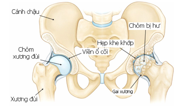 Mẹo nhận biết cơn đau vùng háng và đùi có phải do viêm khớp háng? - 1