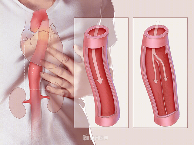 Bác sĩ cấp cứu suốt 10 tiếng người đàn ông đau bụng, thủ phạm là căn bệnh mang tên "kẻ giết người lốc xoáy" - 2