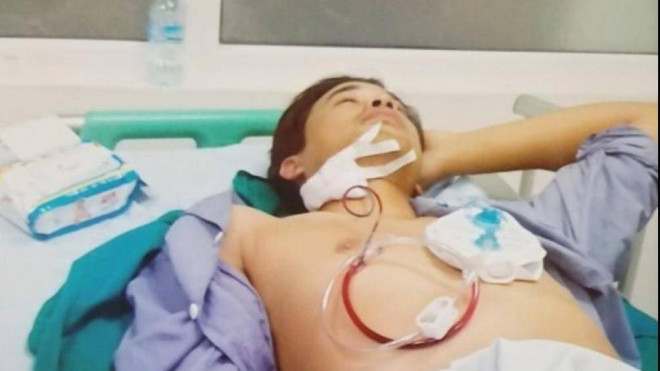 Anh Duy bị vỡ xương hàm, phải phẫu thuật với tỷ lệ thương tật là 15%