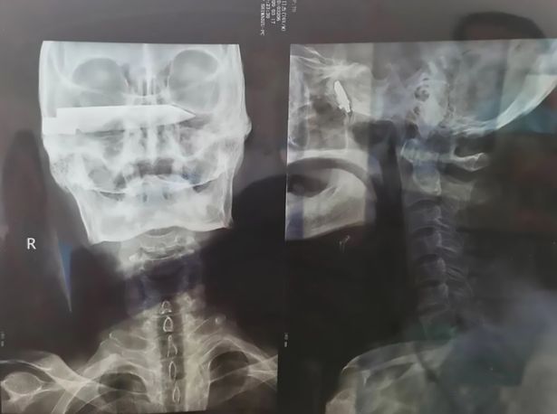 Ảnh chụp X-quang cho thấy con dao cắm vào hộp sọ người đàn ông.
