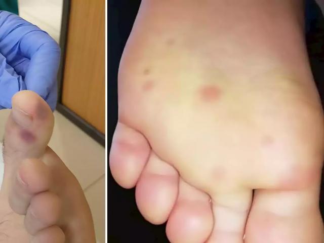 Phát hiện triệu chứng mới xuất hiện ở bàn chân người nhiễm Covid-19