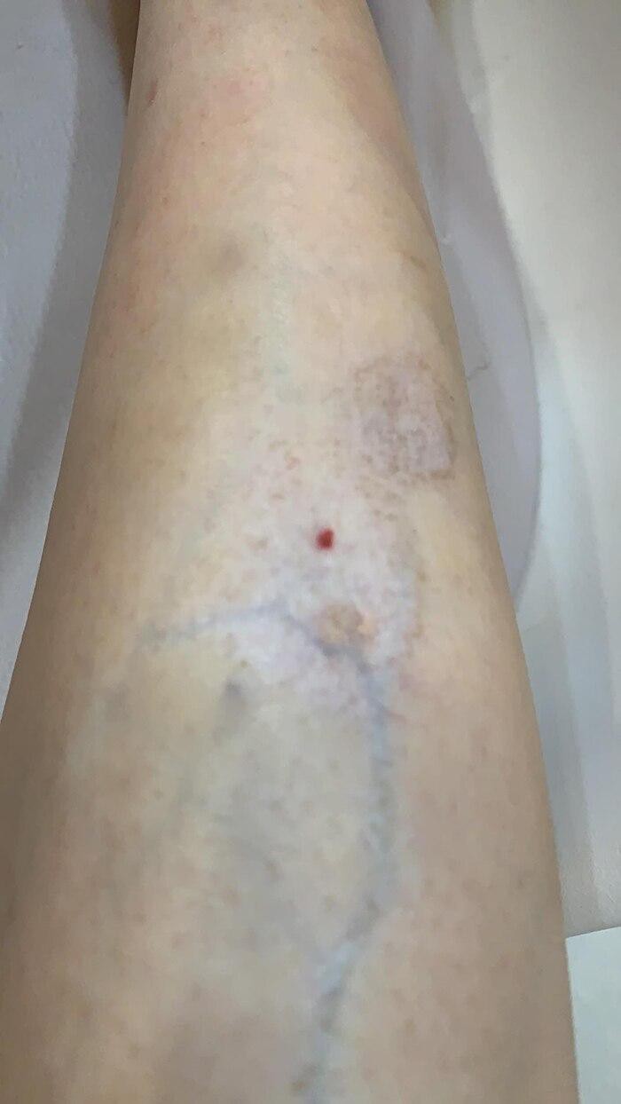 "Hot girl không nội y trong phòng tập" bị teo chân sau khi xoá nốt muỗi đốt - 3