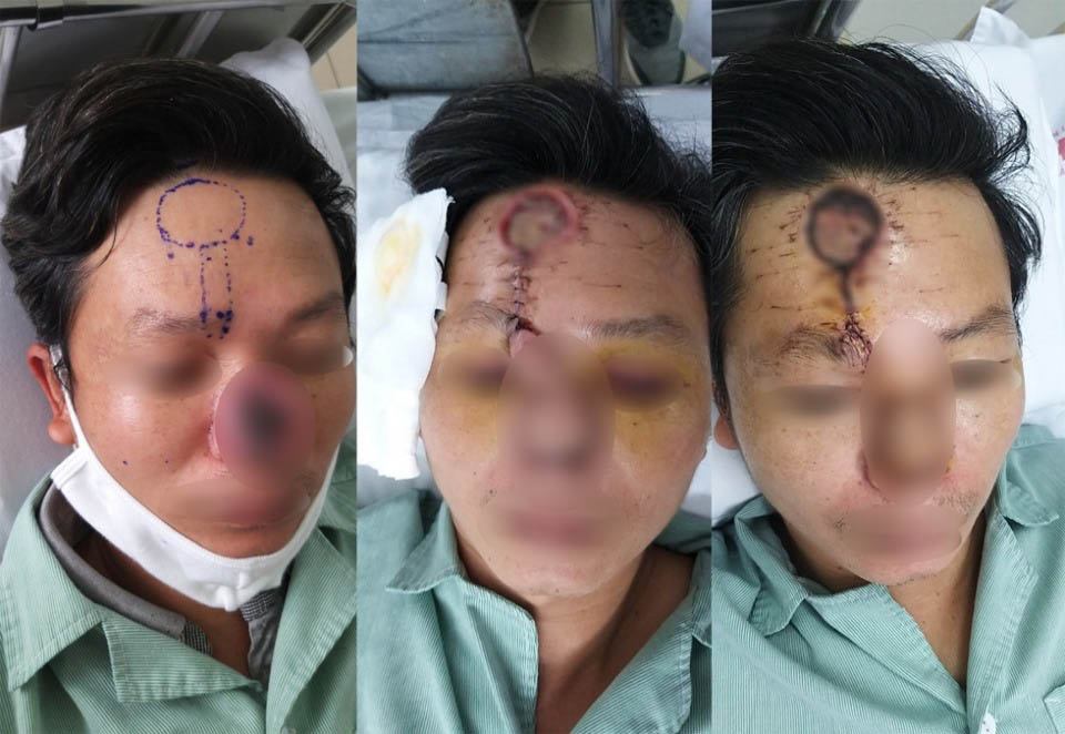 Người đàn ông 42 tuổi có cái mũi đáng sợ sau khi xuất hiện mụn nhỏ - 1