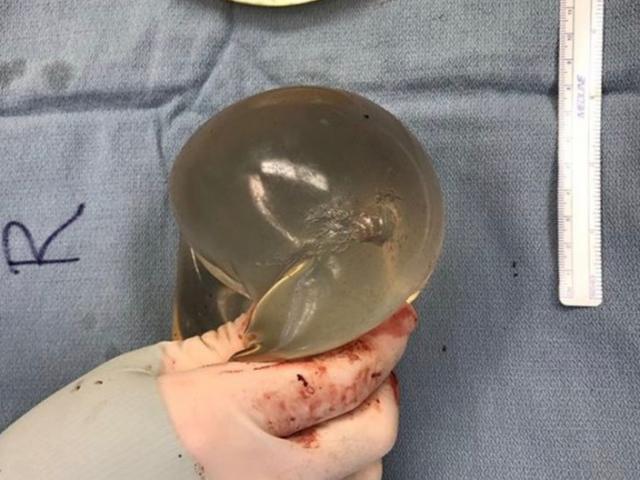 Phi thường - kỳ quặc - Thấy nóng và đau trong ngực, cô gái mới phát hiện mình bị đạn bắn từ lúc nào