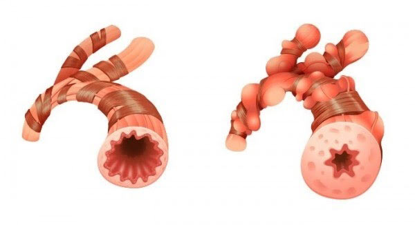 Tái cấu trúc đường thở là nguyên nhân chính gây ho có đờm kéo dài