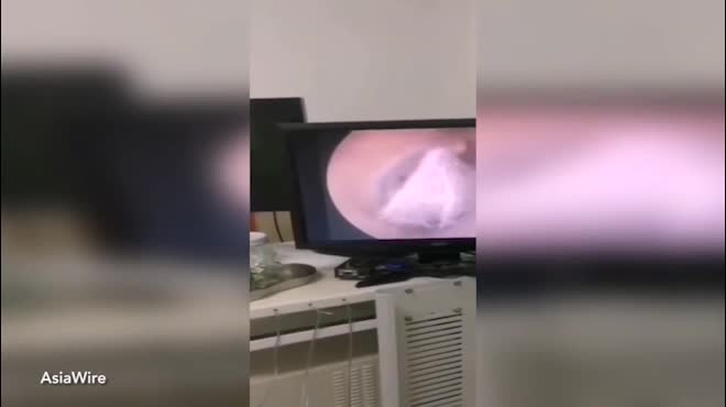 TQ: Phát hiện nhện làm tổ trong tai bệnh nhân suốt 1 tuần