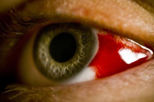 Chảy máu ở mắt là triệu chứng thường thấy của bệnh "khóc ra máu". Ảnh: Getty