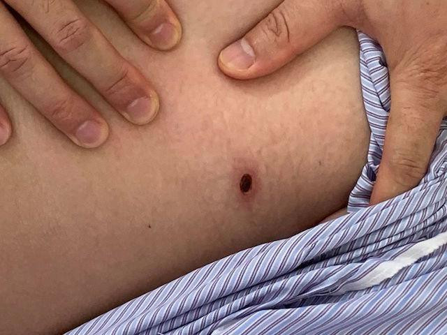 Sức khỏe đời sống - Báo động căn bệnh có thể tử vong chỉ từ một vết loét nhỏ