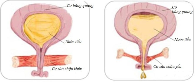 Ho, hắt hơi là “són tiểu” ướt quần, Chị em làm thế nào để cải thiện? - 2