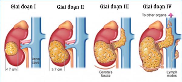 Mách bạn nhận biết sớm ung thư thận - 1