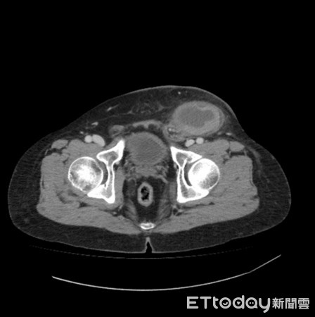 Đau quặn bụng phải nhập viện, tưởng bị về đường ruột nhưng hóa ra là do tinh hoàn - 1