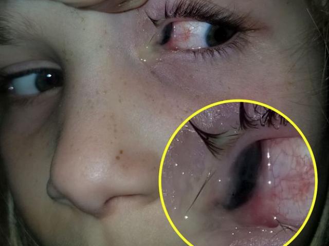 Sức khỏe đời sống - Bọ cánh cứng sống trong mắt bé gái 6 tuổi