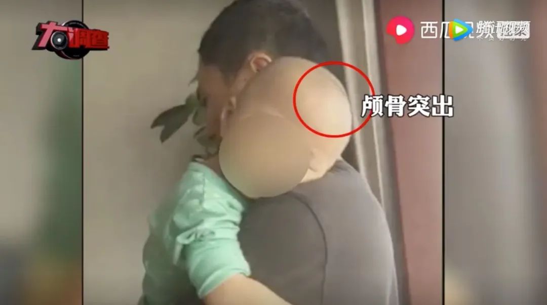 Một bé sử dụng sữa BeiAnMin bị đầu to nhưng mình nhỏ (ảnh: Hoàn Cầu)
