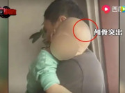Thế giới - Trung Quốc: Xuất hiện loại sữa bột trẻ em uống vào bị bệnh “đầu to mình nhỏ”