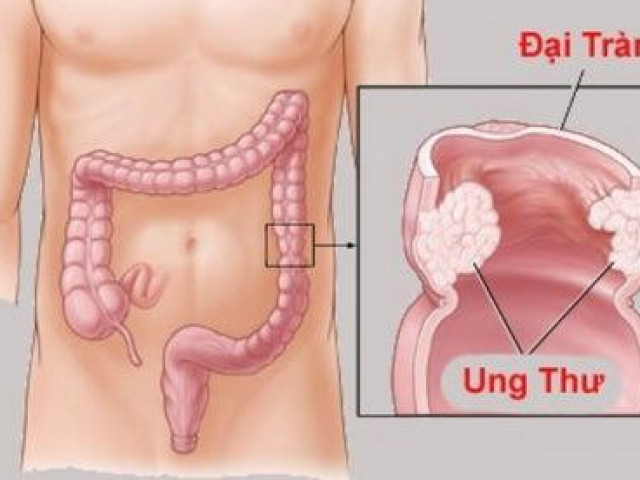 Sức khỏe đời sống - Nhiều người cùng mắc ung thư trong 1 gia đình: BS chỉ ra thủ phạm