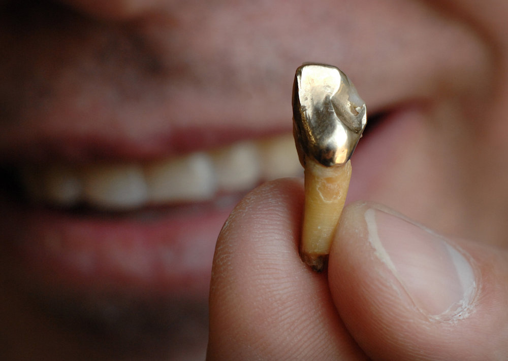 Nghi phạm muốn trộm răng vàng của tử thi để bán lấy tiền (ảnh: BBC)