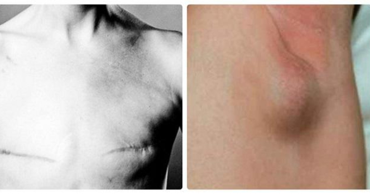 Sức khỏe đời sống - Xuất hiện hạch ở nách, dấu hiệu cảnh báo mắc ung thư gì?