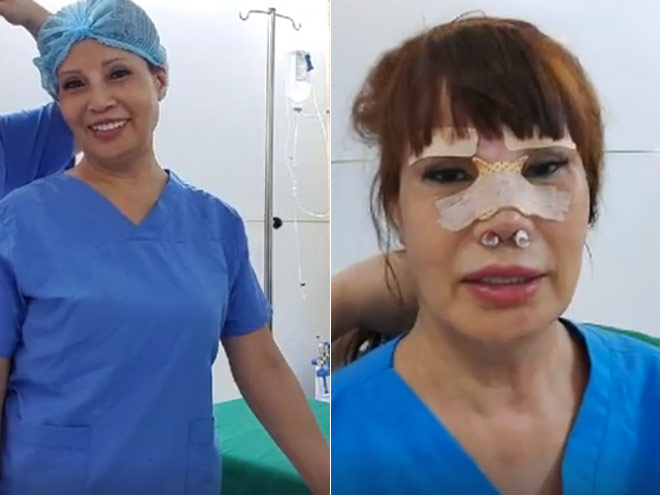 Chị Thu Sao trước và sau khi phẫu thuật nâng mũi