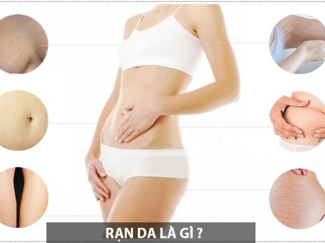 Cách trị rạn da an toàn hiệu quả nhanh nhất tại nhà