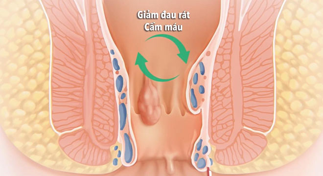 Bệnh trĩ - cách phòng tránh và chữa trị. - 1