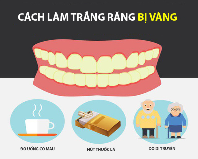 Cách làm trắng răng bị vàng tại nhà an toàn hiệu quả nhanh nhất - 1