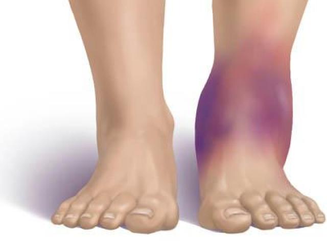 Sức khỏe đời sống - Bị bong gân nên chườm nóng hay chườm lạnh?