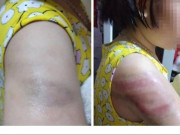 Giáo dục - du học - Học sinh lớp 4 bị cô giáo đánh bầm tím tay vì viết bài chậm