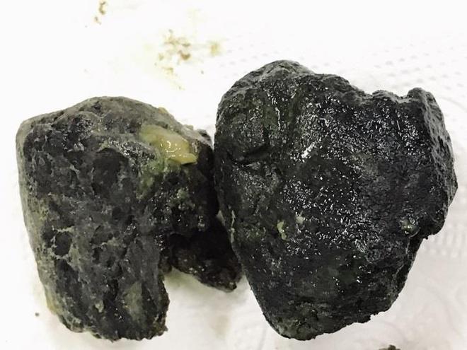 Sức khỏe đời sống - Những "tai nạn" không thể ngờ khi uống trà sữa