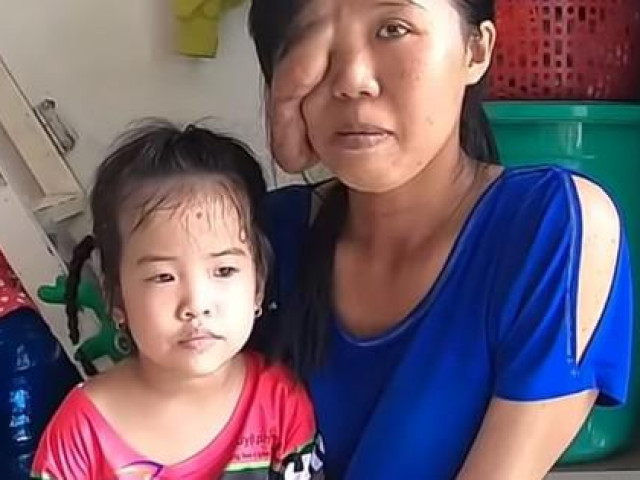 Bạn trẻ - Cuộc sống - Xót xa cảnh đời cô gái bị chồng bỏ đi vì mặt bị biến dạng sau khi sinh con