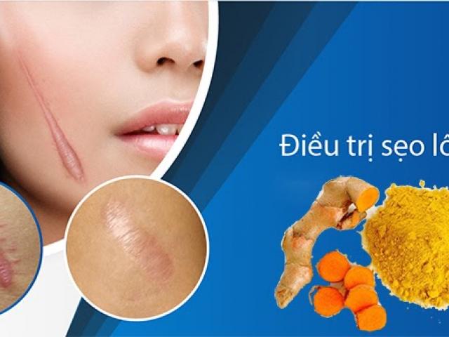 Làm đẹp - Cách trị sẹo lồi an toàn hiệu quả nhanh nhất