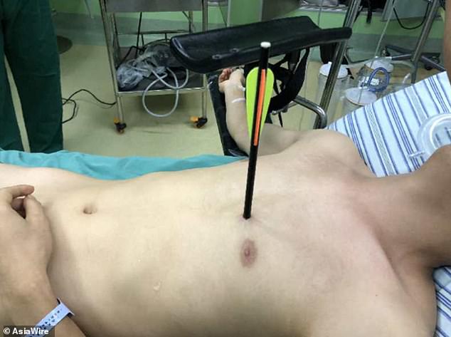 Mũi tên đâm vào ngực một thanh niên Trung Quốc hồi đầu tuần. Ảnh: Asia Wire