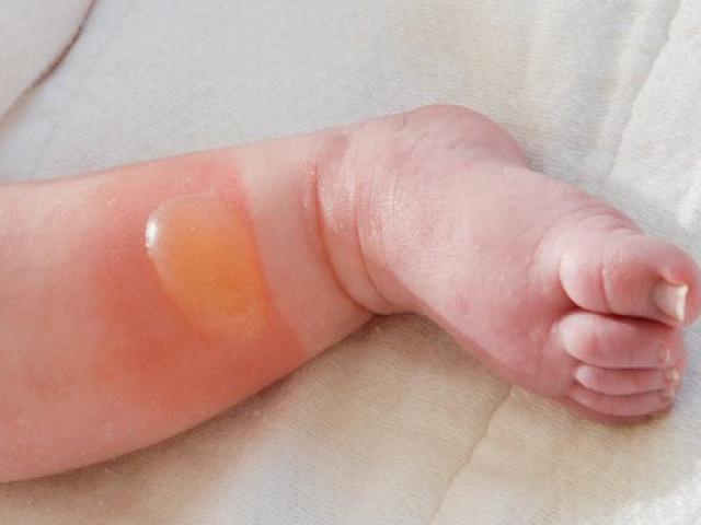Sức khỏe đời sống - Dùng trứng gà, kem đánh răng... chữa bỏng có hiệu quả không?