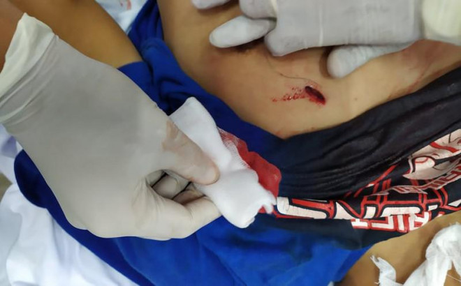Vết thương của nạn nhân đang được các bác sĩ chăm sóc. Ảnh: BVCC